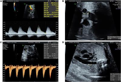 Cardiac Function Assessment in Fetuses With Ductus Arteriosus Constriction: A Two-Dimensional Echocardiography and FetalHQ Study